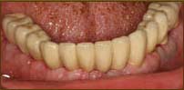 implant with corwns final